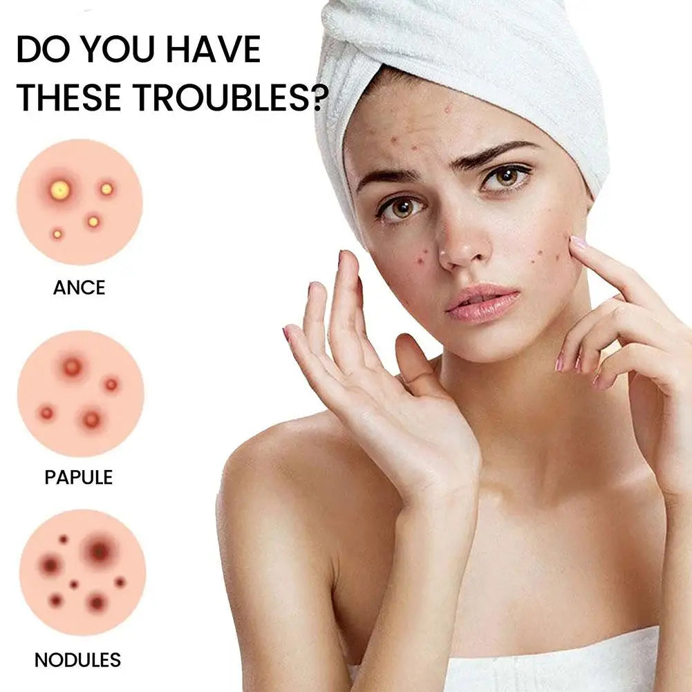 Acne Pimple Patch Stickers Acne Pimple Remover Tool Absorb Pus And Oil Acne Patch Face Skin Care 360 Patches