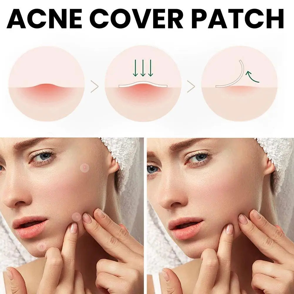 Acne Pimple Patch Stickers Acne Pimple Remover Tool Absorb Pus And Oil Acne Patch Face Skin Care 360 Patches